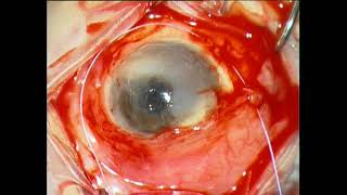 Morbus Miniwarter Burger and eye surgery