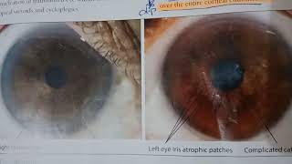 Fuchs uveitis
