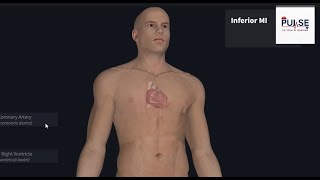 Inferior Wall MI: ECG Changes#heartattack #hearthealth #heart #health #anatomy #block #amazingfacts
