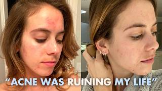 The Acne Episode (so many things I didn’t know about breakouts)