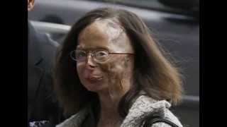 Acid attack victim