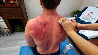ASMR: Gua Sha Massage in China Left My Back Seriously Bruised