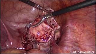 Laparoscopic removal of right 15 cm left 4 cm endometrioma, myomectomy and ovarian suturing