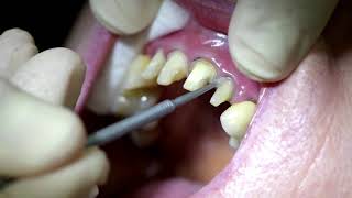 Cementation of Katana STML Crowns with Panavia V5