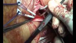 Pelvic Floor Repair System - The Total Implant