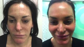 Neogen Plasma Skin treatment