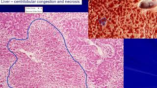 Liver: Chronic venous congestion