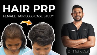 Hair PRP: Too Good To Be True ? Female Hair Loss Case Study By Dr. Asif #prptreatment