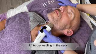RF Microneedling with Vitamin C Infusion