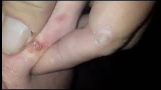 #pimples #pimple #zits #zit #skincare ##whiteheads #boil #health #life #doctor #medical #nurse #body