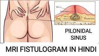 What is Pilonidal Sinus | MRI of Pilonidal Sinus Protocol.