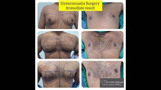 Are you ready for a new beginning? #gynecomastiasurgery #plasticsurgery #Aestheticanepal ##drsanjib