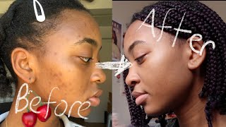 my skin care routine✨how I got rid of acne and hyperpigmentation