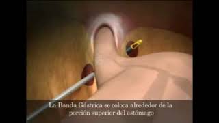 Banda Gástrica