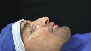 Before & After Jaw Surgery – 7 Day Recovery of Punjab Patient