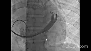 Cardiac Resynchronization Therapy in AIIMS Bhubaneswar in 10 steps