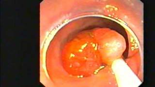 Endoscopy Master Videos: Colonoscopy Polypectomy @ www.gastroliver.com.sg