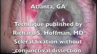 IOL Rescue, Hoffman Scleral Fixation