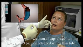 What is Allurion Program? learn more with Dr. Hady Jerdak