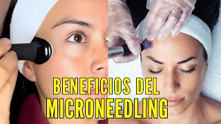 Microaguja en casa: TODO lo que necesitas saber antes de empezar