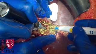 Open Right Hepatic Trisegmentectomy with “Hanging” Maneuver + Portal Vein Reconstruction