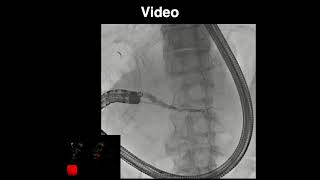Endoscopic ultrasound-guided pancreaticoduodenostomy with a forward-viewing echoendoscope