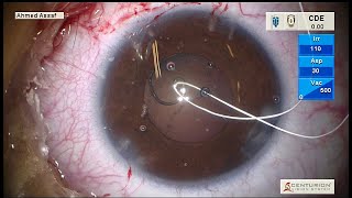 Managing Lens Sublaxation- LIVE STREAM
