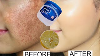 Vaseline and lemon for skin whitening | Vaseline for pigmentation and dark spots on face