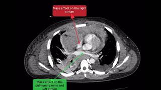 Huge mediastinal lymphoma