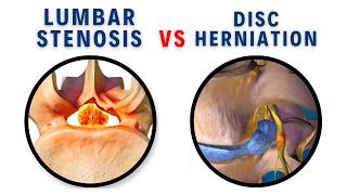Lumbar Stenosis vs Herniated Disc: 5 Signs You Must Know Before Your MRI | Dr. John Zielonka