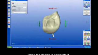 Single visit CEREC porcelain crown.mp4