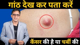 शरीर में कैंसर की और चर्बी की गांठ का पता कैसे लगाए