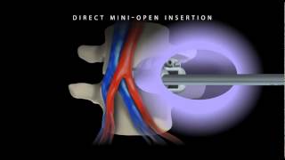 ROI-A Oblique ALIF Cage