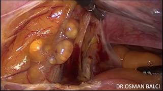 Total Laparoscopic Hysterectomy for a Large Uterus 760 gr