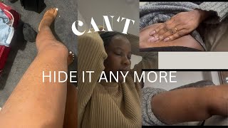 THIS IS EMBARRASSING..My skin Since I MOVED to UK 🇬🇧 😭😭