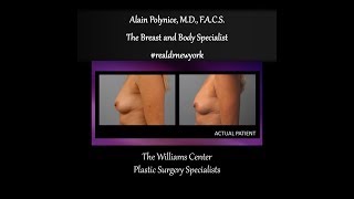 Hot Topic with Dr. Alain Polynice ~Breast Augmentation with Fat Transfers