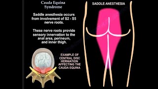 Cauda Equina Syndrome Urgent Diagnosis and Treatment