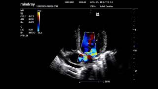 Mindray M6 echocardiography portable ultrasound machine