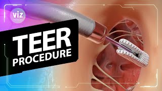 How a tiny clip can support a leaky heart valve (3D Animation)