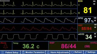 Simulated Adult Patient ICU Monitor with Hypotension (Low Blood Pressure)
