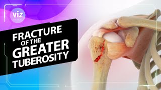 Fracture of the Greater Tuberosity (3D Animation)
