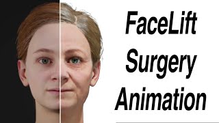 FaceLift Surgery Animation