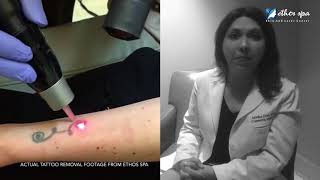 Laser Tattoo Removal at Ethos Spa