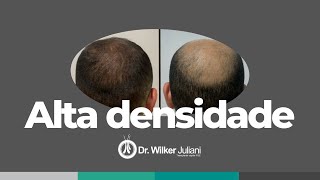 Alta densidade no Transplante capilar