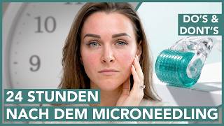 The first 24 hours after microneedling: what is allowed – what is taboo?
