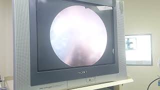 bladder stone