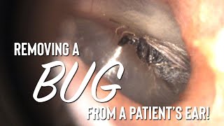 Removing an INSECT from a Patient's Ear!