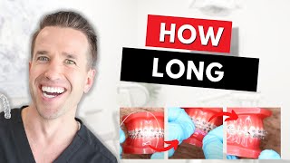 How long do braces take?