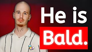 Is Socksfor1 actually bald?