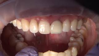 Chairside Live Episode 207: BioTemps® Provisionals in the Anterior